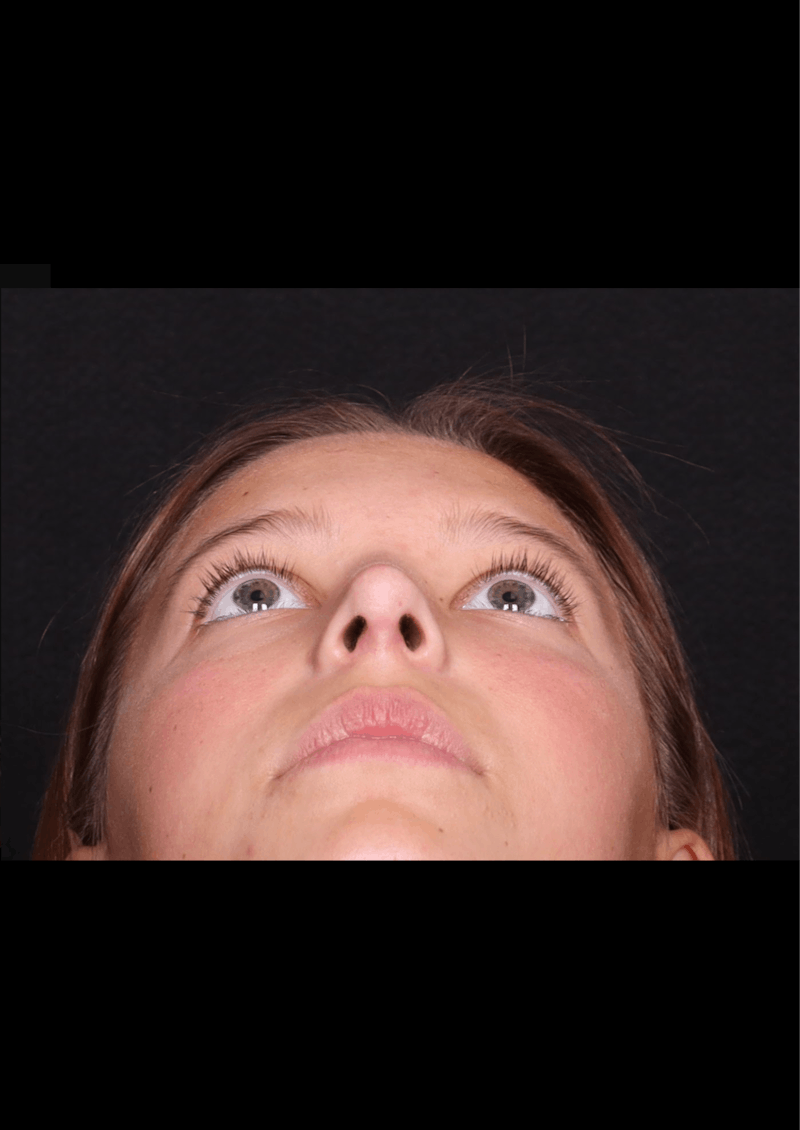 Rhinoplasty Female Before & After Gallery - Patient 388448 - Image 4