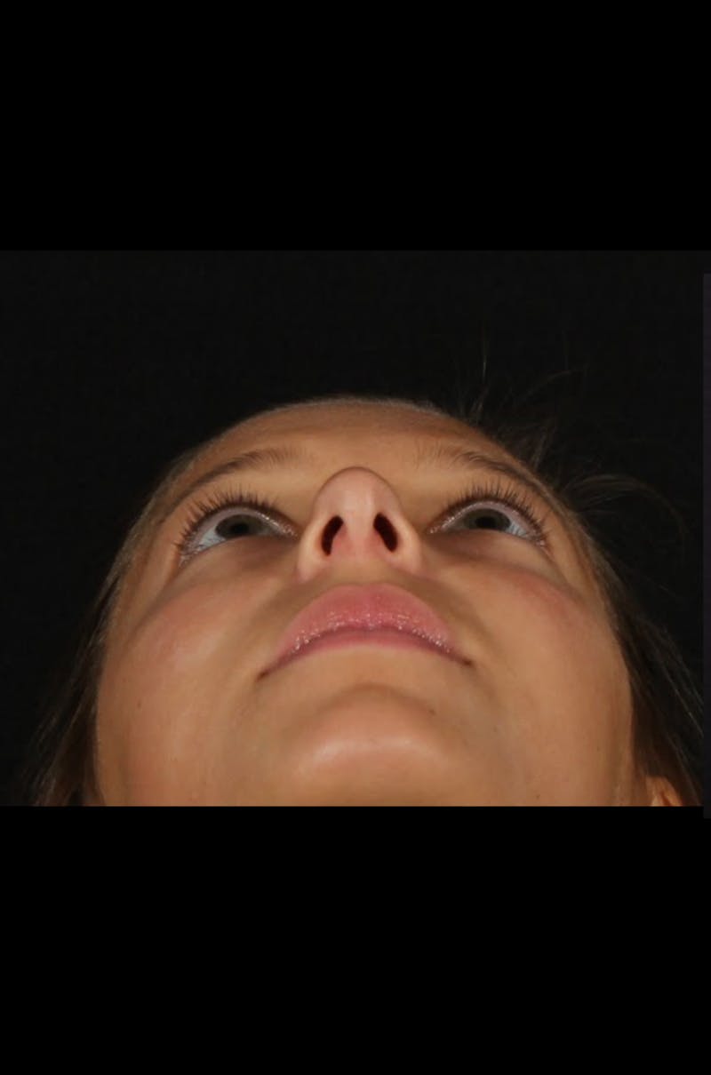 Rhinoplasty Female Before & After Gallery - Patient 388448 - Image 3