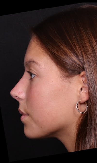 Rhinoplasty Female Before & After Gallery - Patient 388448 - Image 2