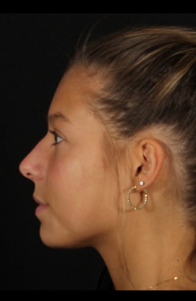 Rhinoplasty Female Before & After Gallery - Patient 388448 - Image 1