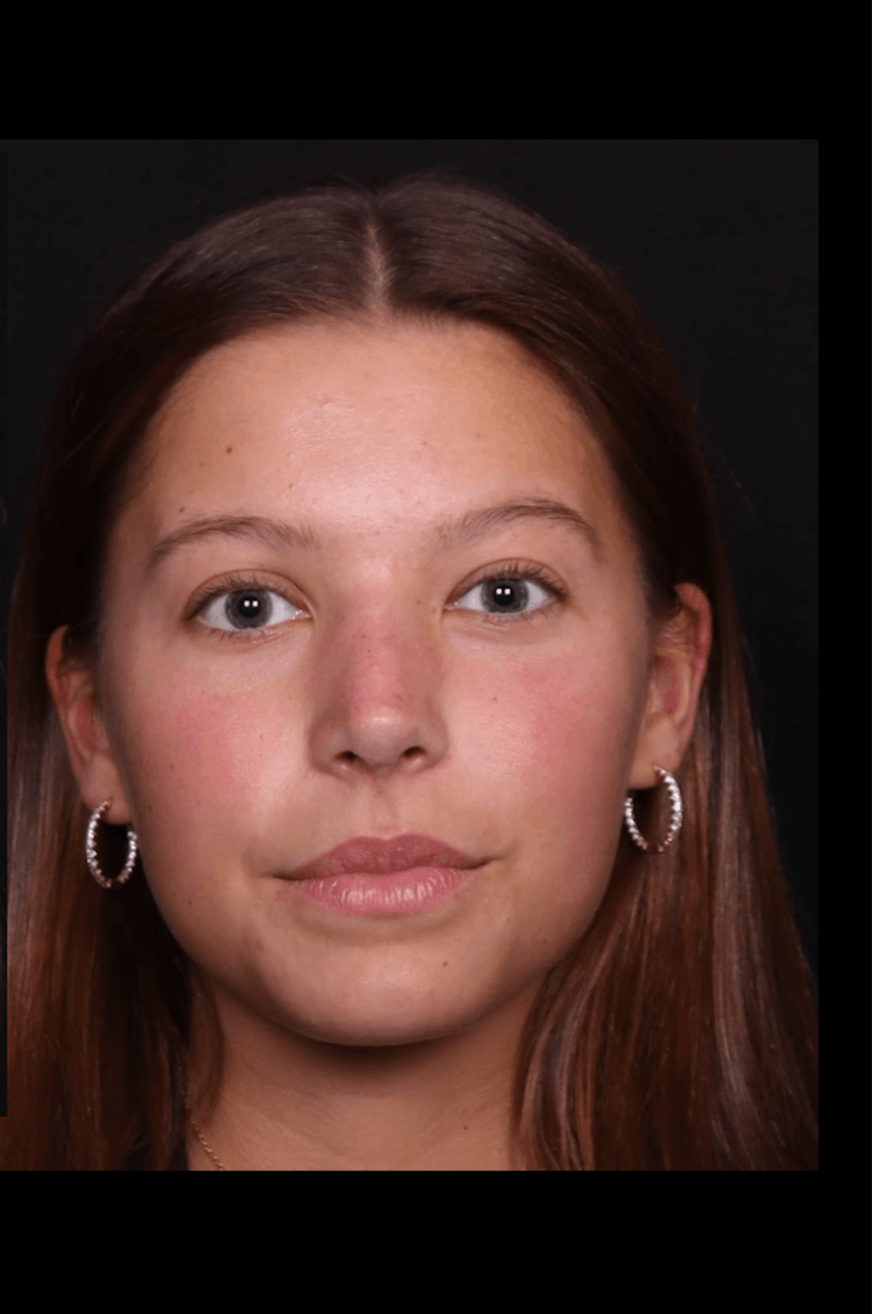 Rhinoplasty Female Before & After Gallery - Patient 388448 - Image 6