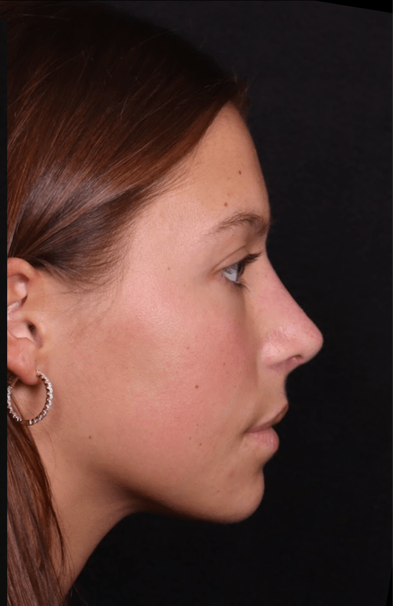 Rhinoplasty Female Before & After Gallery - Patient 388448 - Image 8