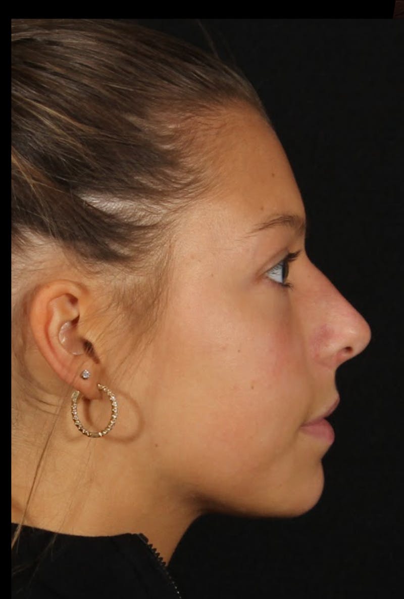 Rhinoplasty Female Before & After Gallery - Patient 388448 - Image 7