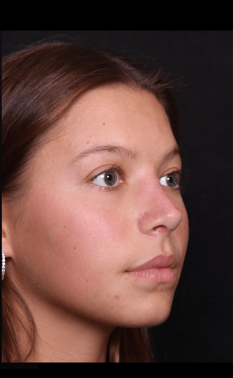 Rhinoplasty Female Before & After Gallery - Patient 388448 - Image 10