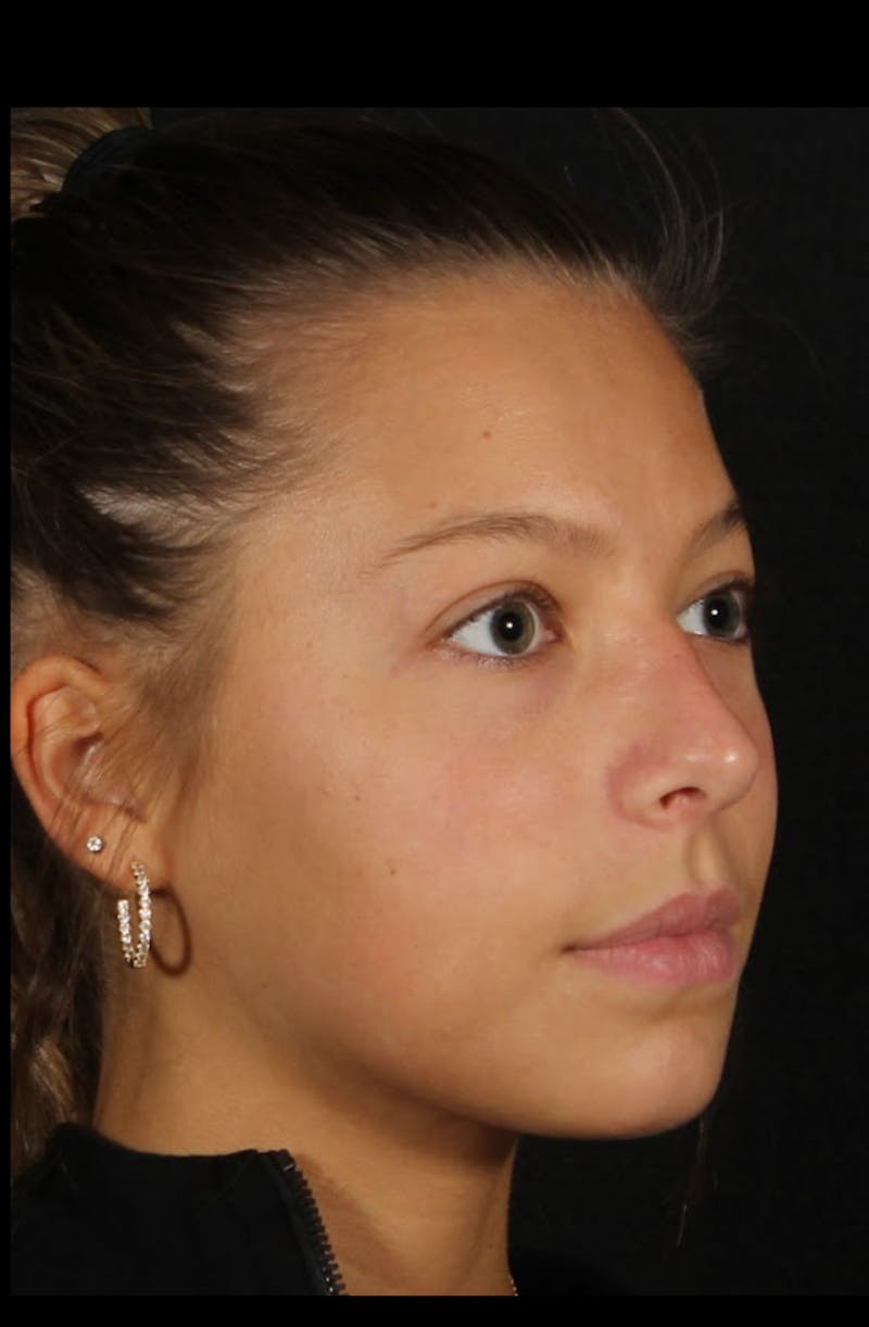 Rhinoplasty Female Before & After Gallery - Patient 388448 - Image 9