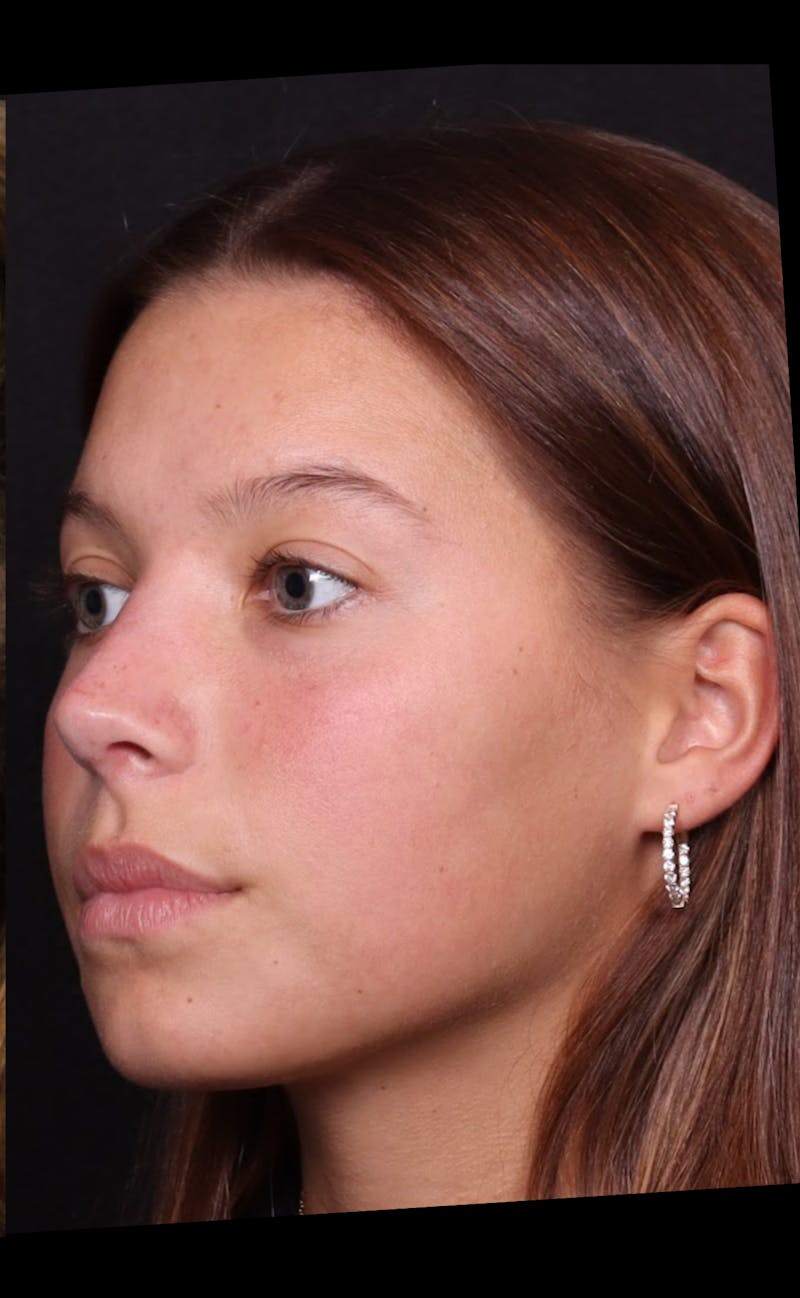 Rhinoplasty Female Before & After Gallery - Patient 388448 - Image 12