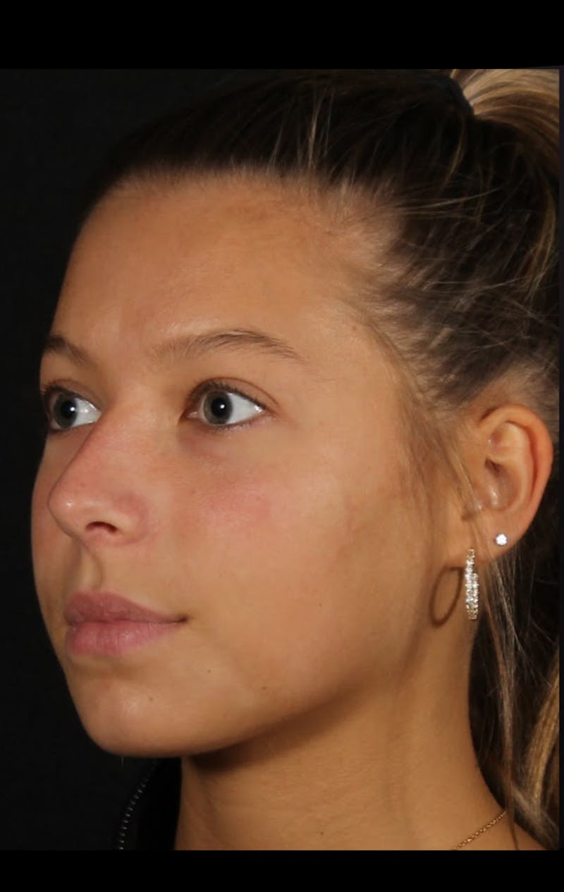 Rhinoplasty Female Before & After Gallery - Patient 388448 - Image 11