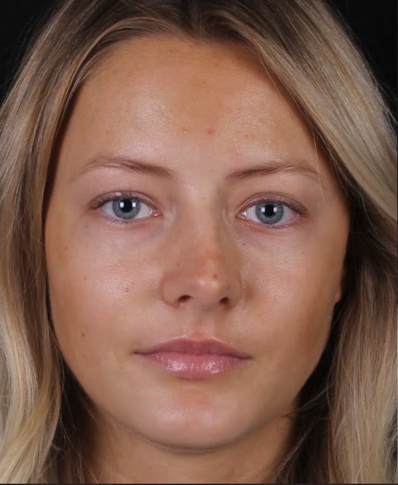 Rhinoplasty Female Before & After Gallery - Patient 102194 - Image 3