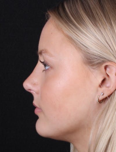 Rhinoplasty Female Before & After Gallery - Patient 102194 - Image 2