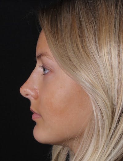 Rhinoplasty Female Before & After Gallery - Patient 102194 - Image 1