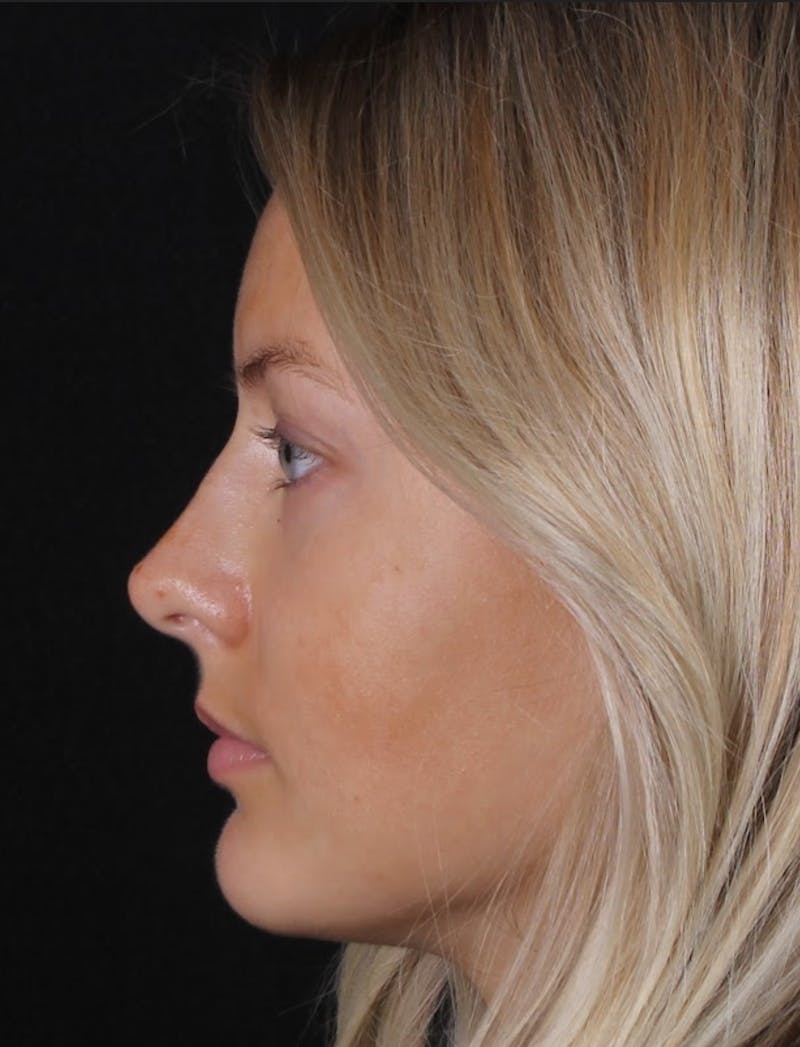 Rhinoplasty Female Before & After Gallery - Patient 102194 - Image 1