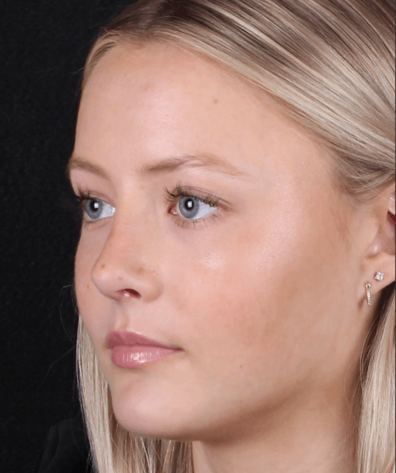 Rhinoplasty Female Before & After Gallery - Patient 102194 - Image 6