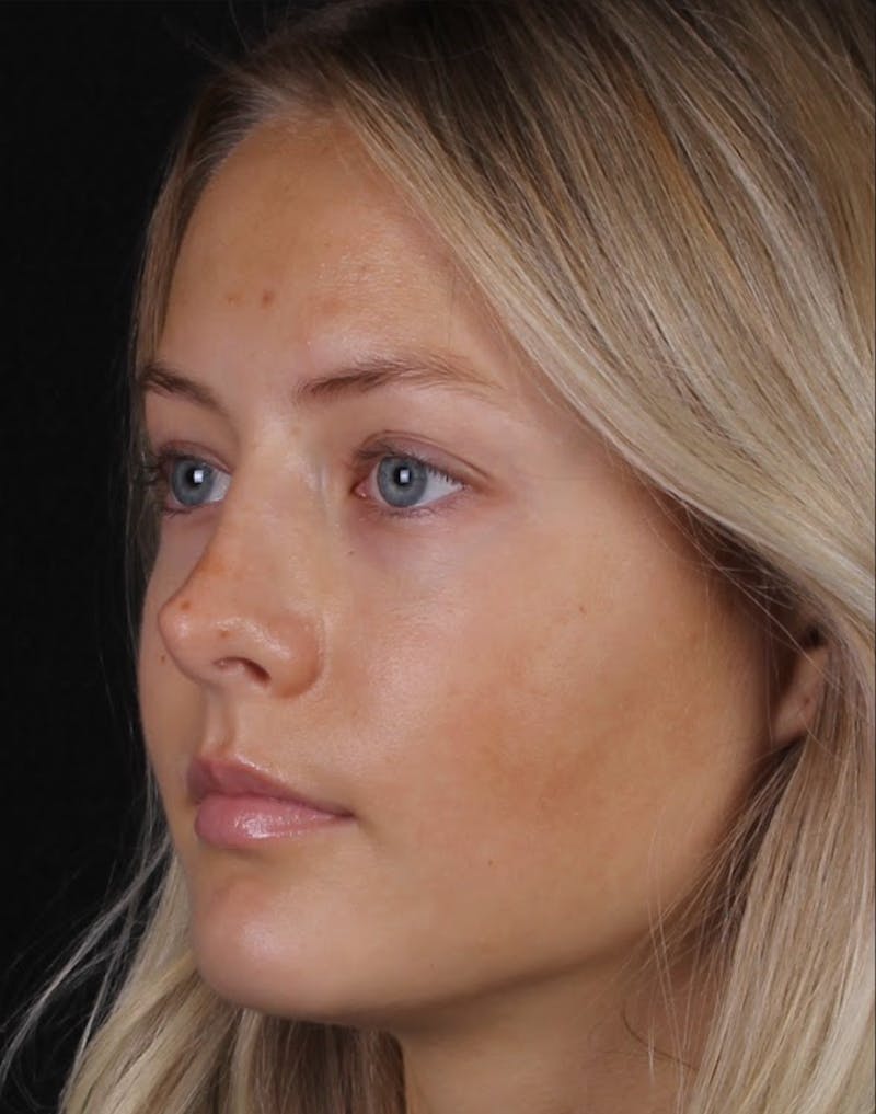 Rhinoplasty Female Before & After Gallery - Patient 102194 - Image 5