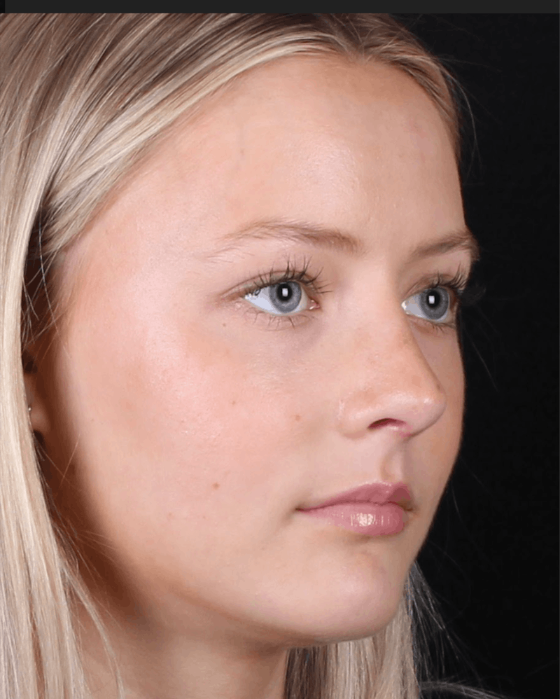 Rhinoplasty Female Before & After Gallery - Patient 102194 - Image 8