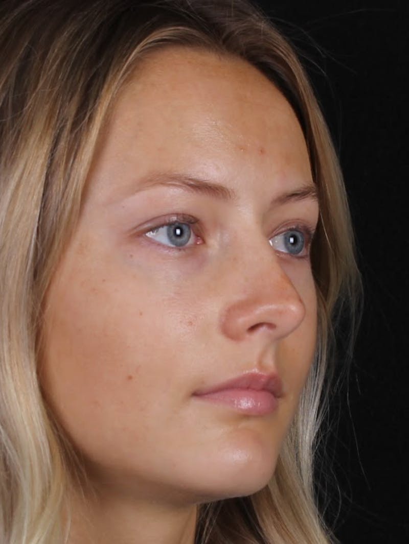 Rhinoplasty Female Before & After Gallery - Patient 102194 - Image 7