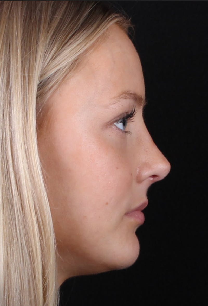 Rhinoplasty Female Before & After Gallery - Patient 102194 - Image 10