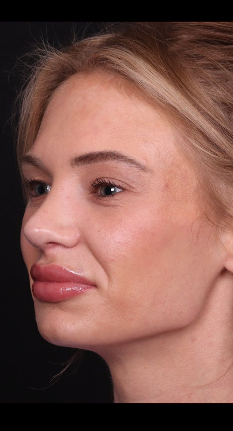Rhinoplasty Female Before & After Gallery - Patient 221457 - Image 6