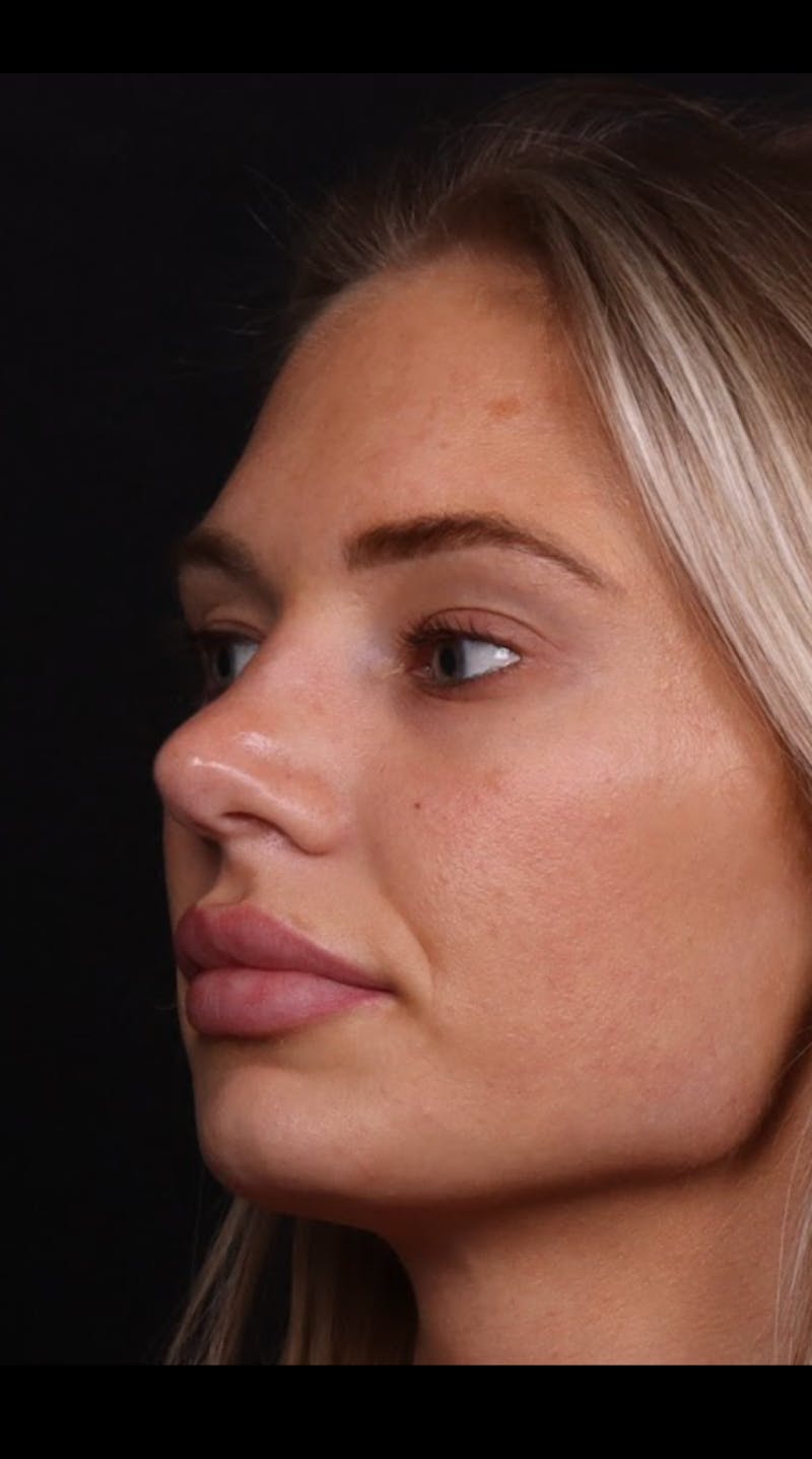 Rhinoplasty Female Before & After Gallery - Patient 221457 - Image 5