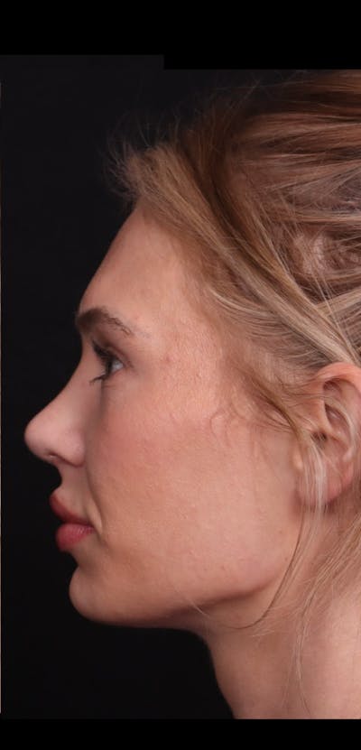 Rhinoplasty Female Before & After Gallery - Patient 221457 - Image 2