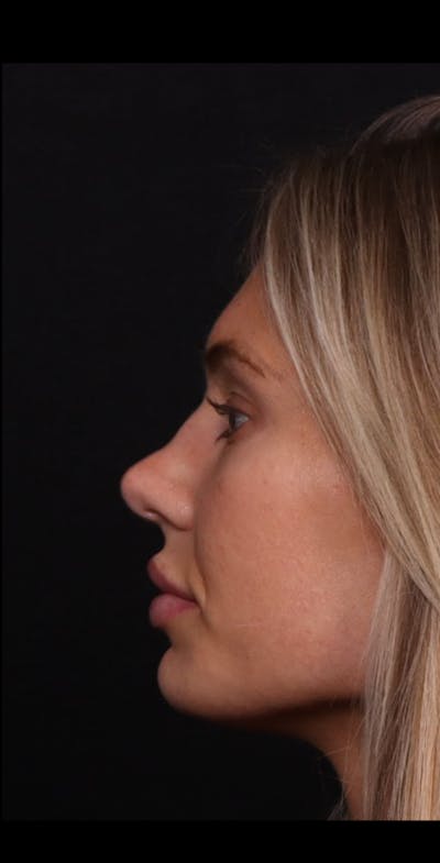 Rhinoplasty Female Before & After Gallery - Patient 221457 - Image 1