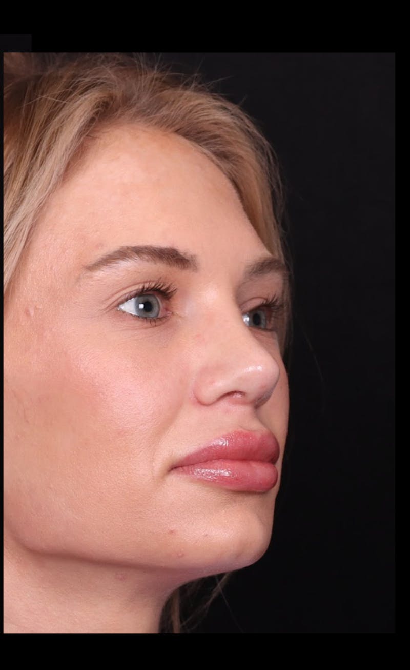 Rhinoplasty Female Before & After Gallery - Patient 221457 - Image 8