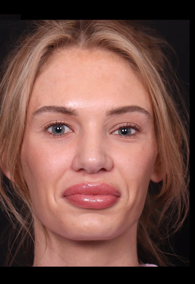 Rhinoplasty Female Before & After Gallery - Patient 221457 - Image 4