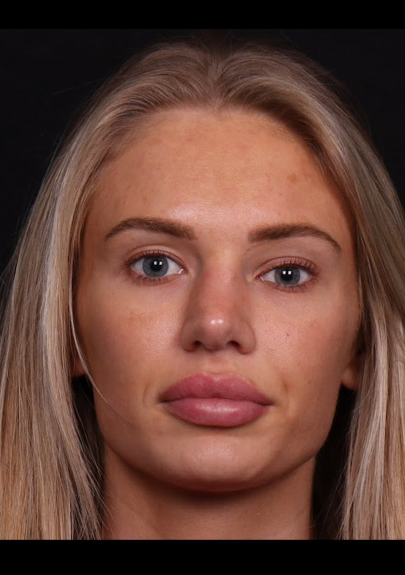 Rhinoplasty Female Before & After Gallery - Patient 221457 - Image 3