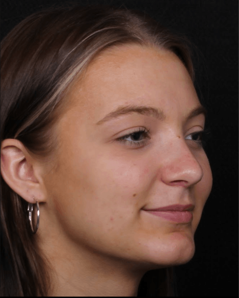 Rhinoplasty Female Before & After Gallery - Patient 208373 - Image 8