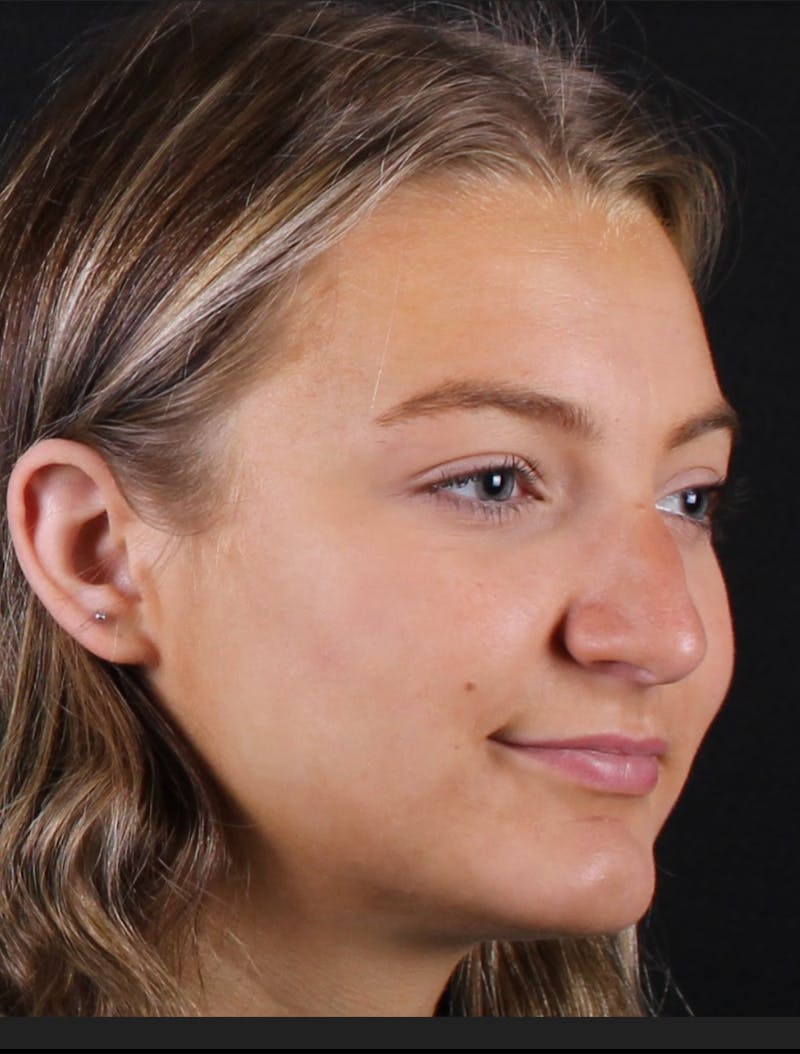 Rhinoplasty Female Before & After Gallery - Patient 208373 - Image 7