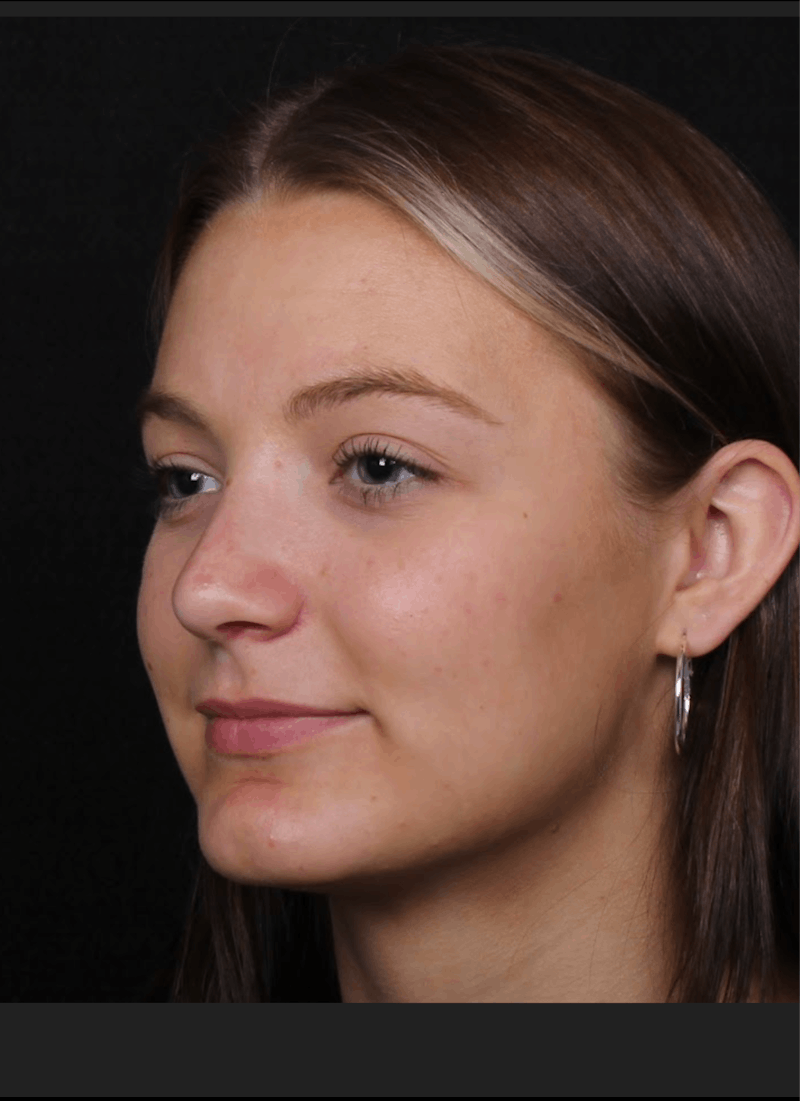 Rhinoplasty Female Before & After Gallery - Patient 208373 - Image 10