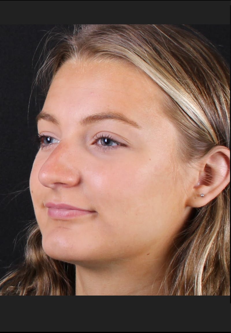 Rhinoplasty Female Before & After Gallery - Patient 208373 - Image 9