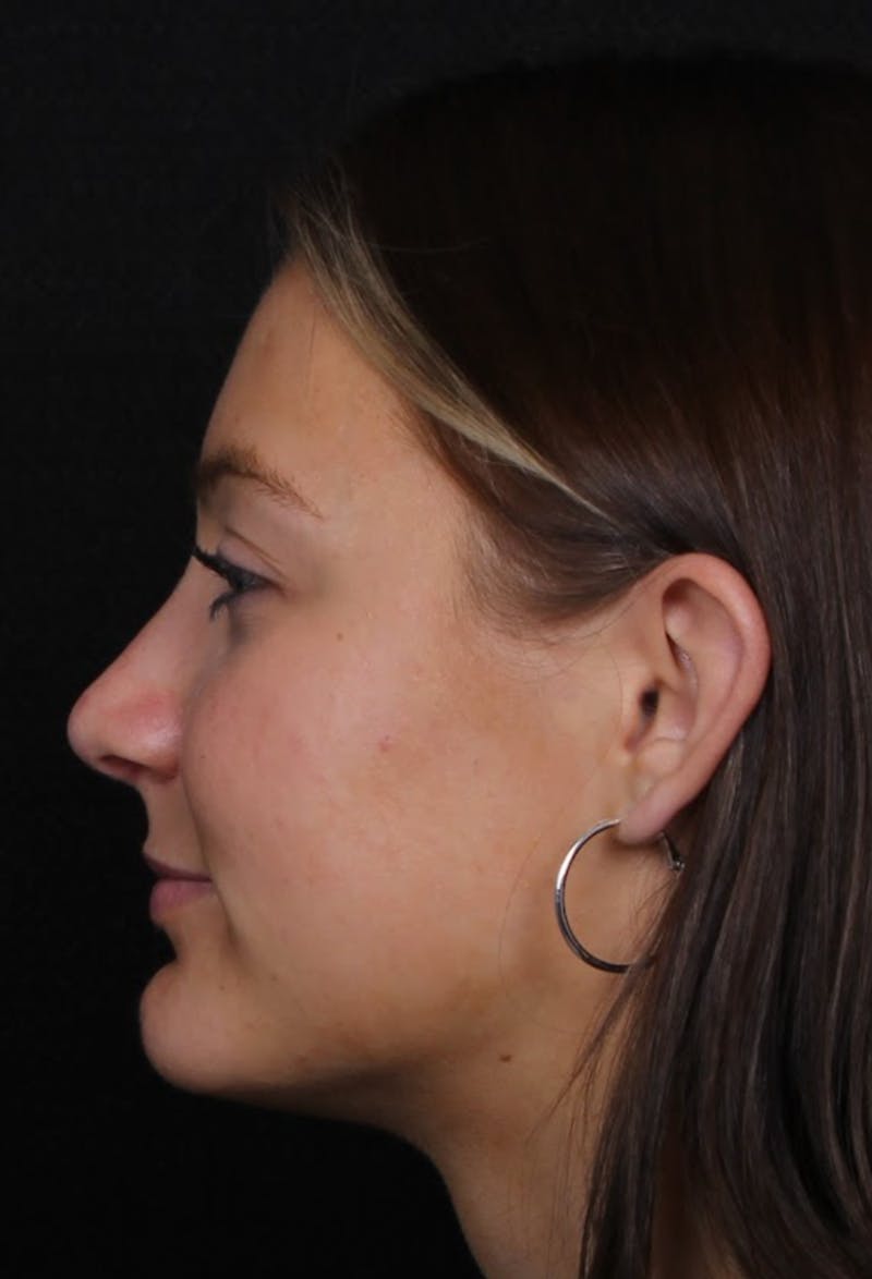 Rhinoplasty Female Before & After Gallery - Patient 208373 - Image 6
