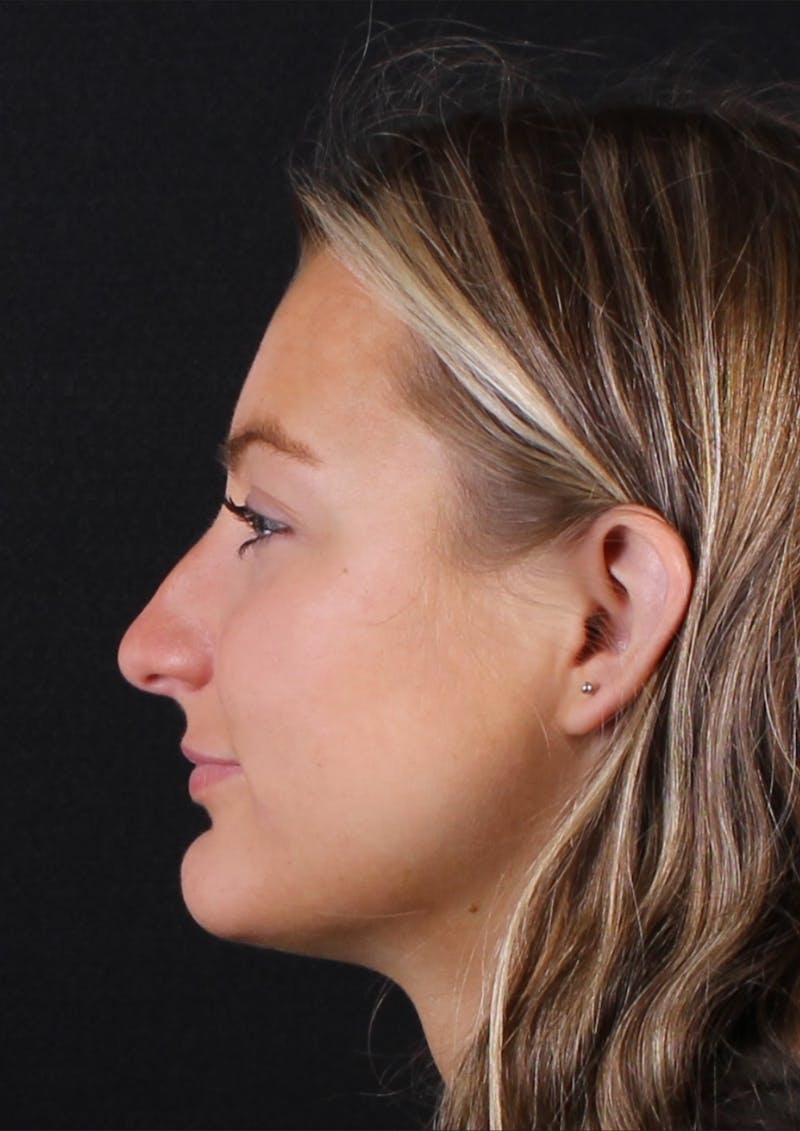 Rhinoplasty Female Before & After Gallery - Patient 208373 - Image 5