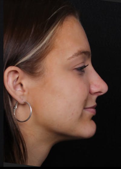 Rhinoplasty Female Before & After Gallery - Patient 208373 - Image 2