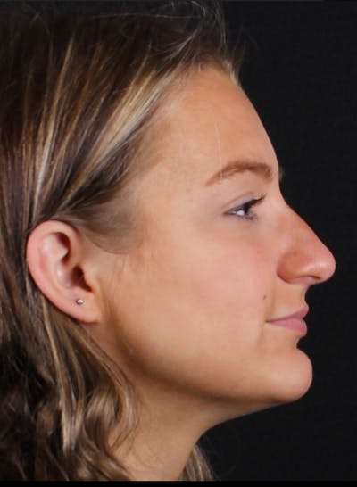 Rhinoplasty Female Before & After Gallery - Patient 208373 - Image 1