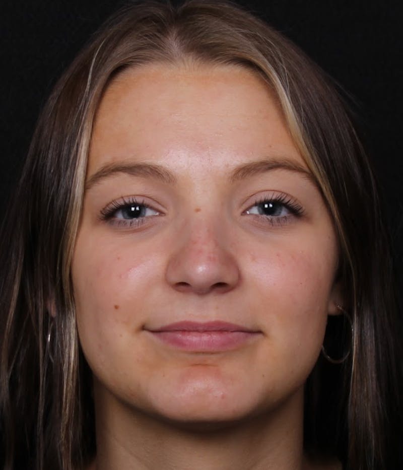 Rhinoplasty Female Before & After Gallery - Patient 208373 - Image 4