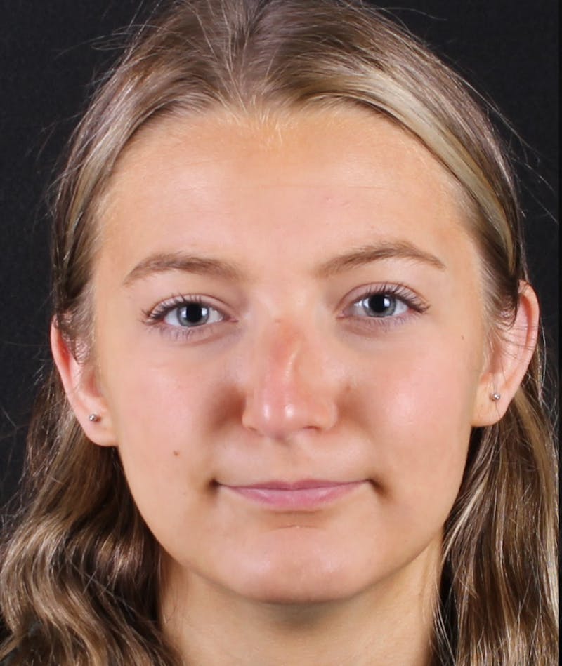 Rhinoplasty Female Before & After Gallery - Patient 208373 - Image 3