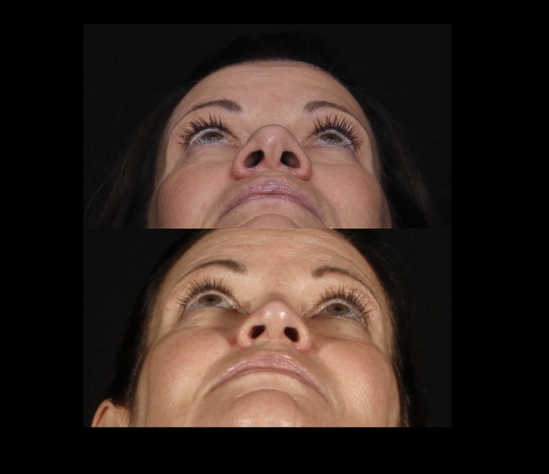 Rhinoplasty Female Before & After Gallery - Patient 707031 - Image 9