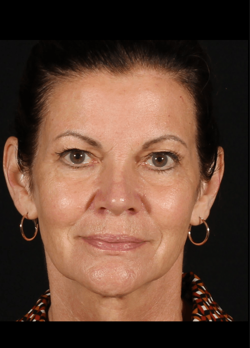 Rhinoplasty Female Before & After Gallery - Patient 707031 - Image 4