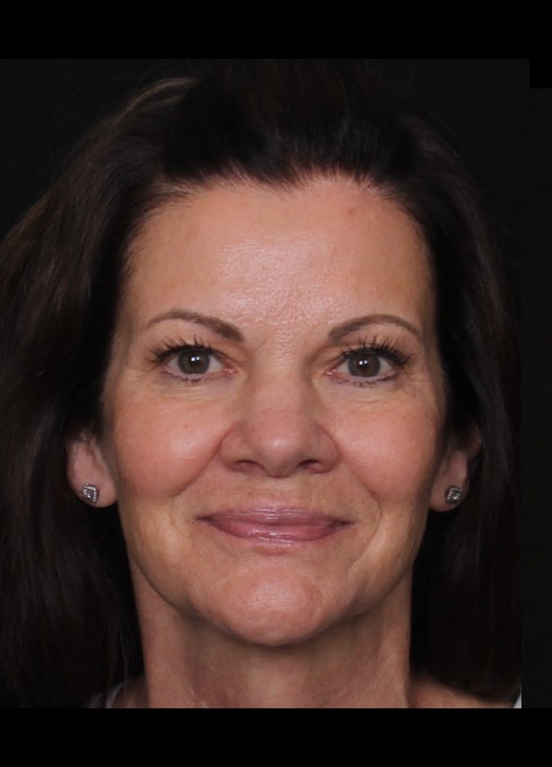 Rhinoplasty Female Before & After Gallery - Patient 707031 - Image 3