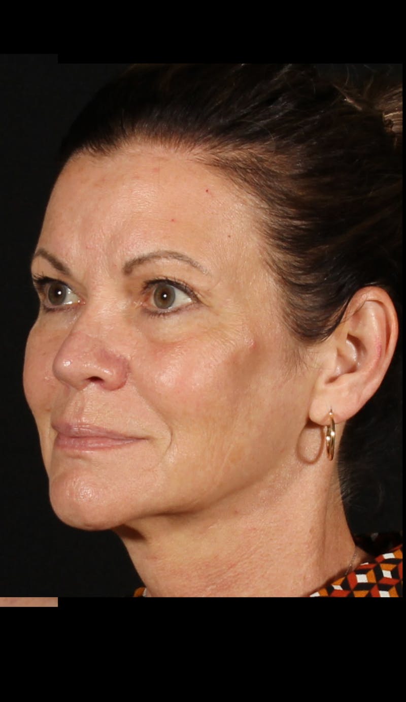 Rhinoplasty Female Before & After Gallery - Patient 707031 - Image 6