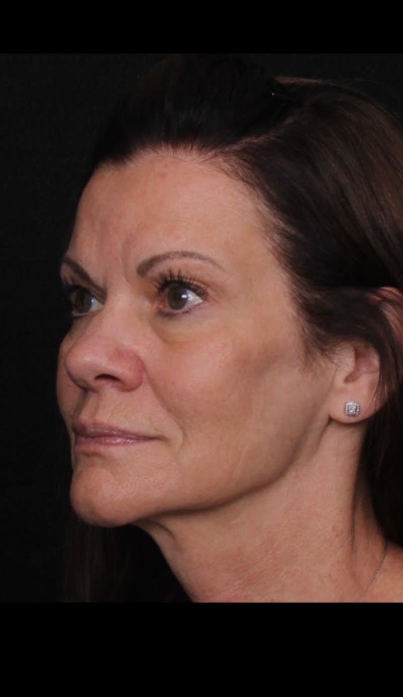 Rhinoplasty Female Before & After Gallery - Patient 707031 - Image 5