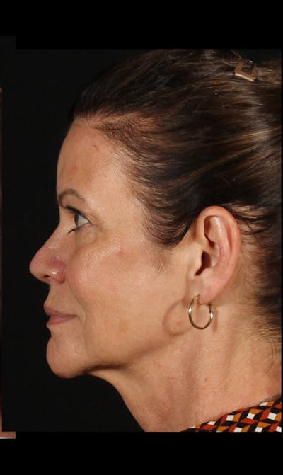 Rhinoplasty Female Before & After Gallery - Patient 707031 - Image 2