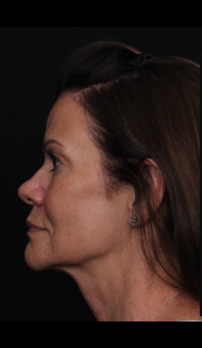 Rhinoplasty Female Before & After Gallery - Patient 707031 - Image 1