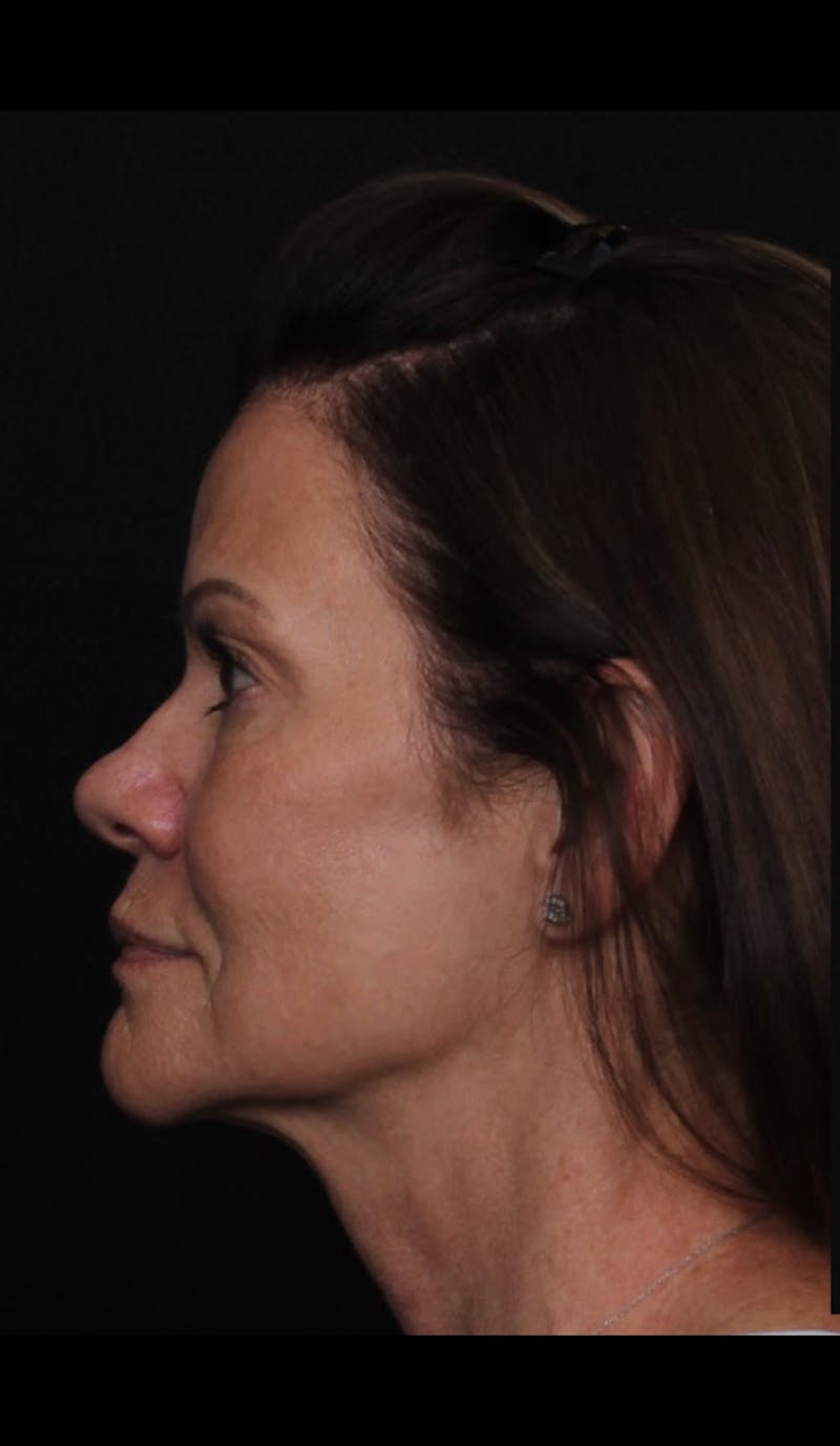 Rhinoplasty Female Before & After Gallery - Patient 707031 - Image 1