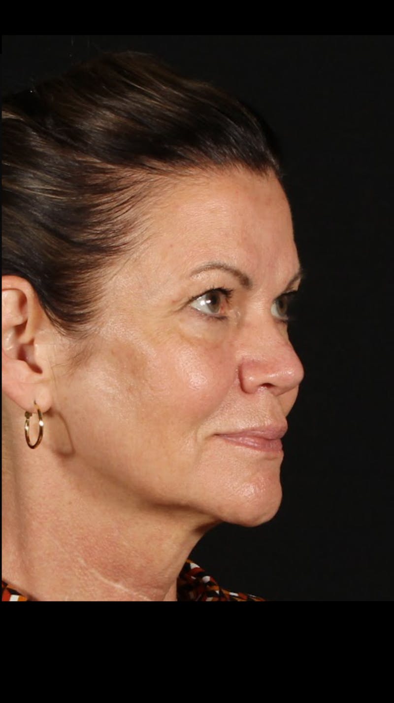 Rhinoplasty Female Before & After Gallery - Patient 707031 - Image 8