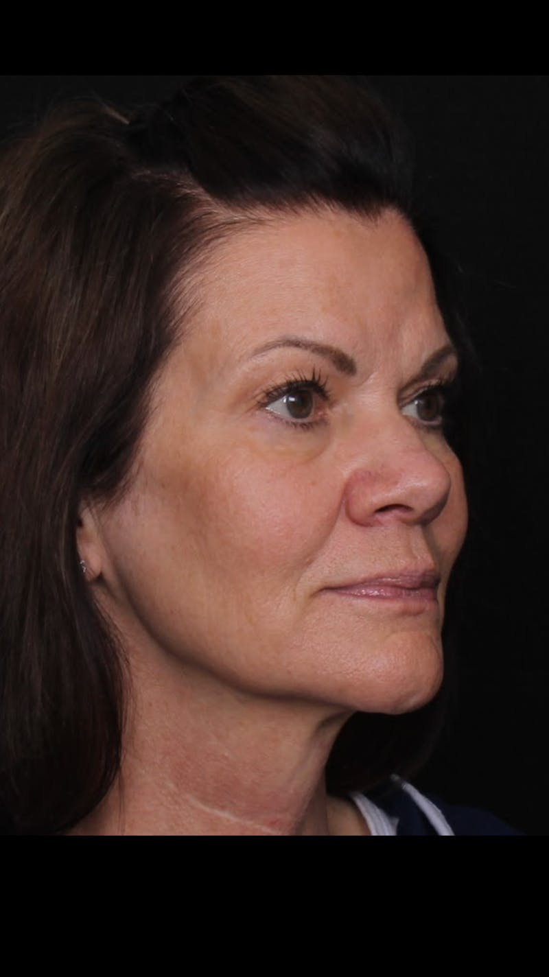 Rhinoplasty Female Before & After Gallery - Patient 707031 - Image 7