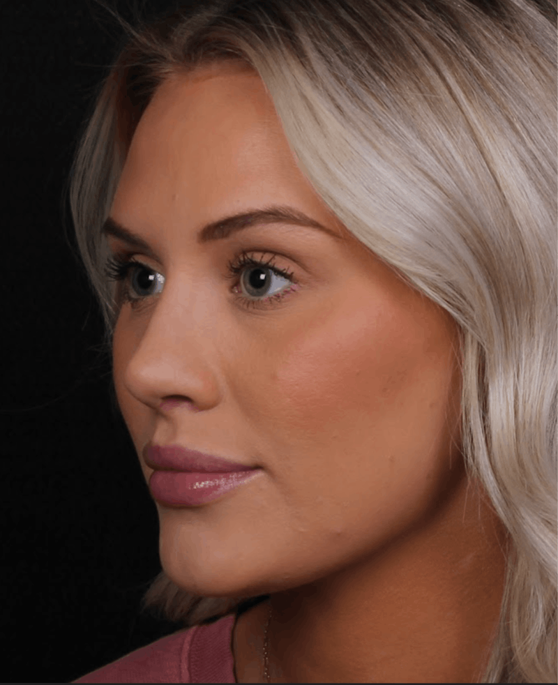 Rhinoplasty Female Before & After Gallery - Patient 194684 - Image 8