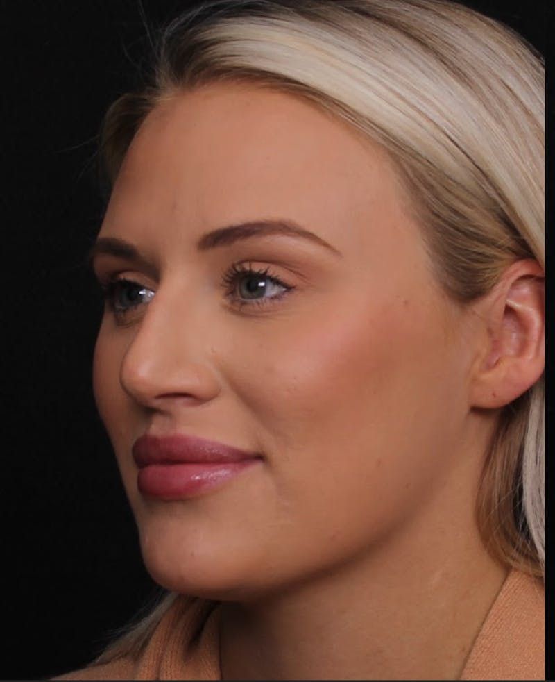 Rhinoplasty Female Before & After Gallery - Patient 194684 - Image 7
