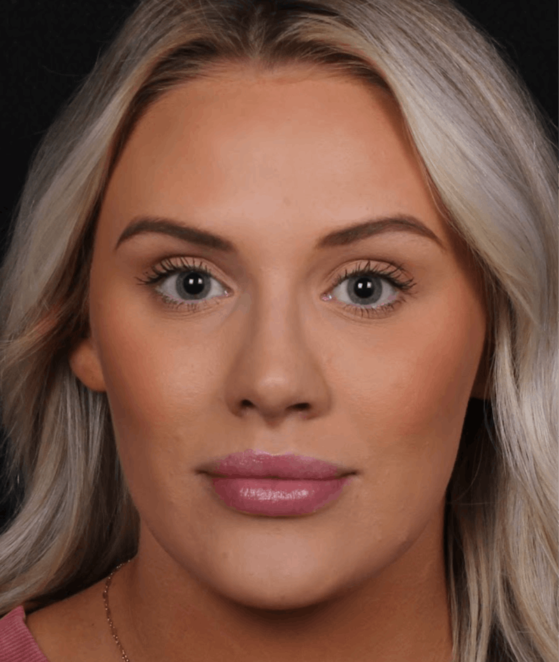 Rhinoplasty Female Before & After Gallery - Patient 194684 - Image 4